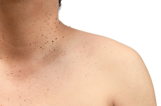 Closed up the skin tags or Seborrheic Keratosis on neck
