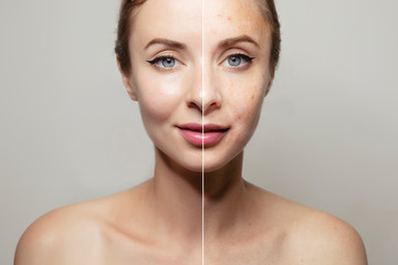 woman face portrait halved with clear and pimpled skin