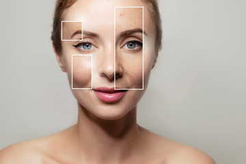 woman face portrait with clear and pimpled skin