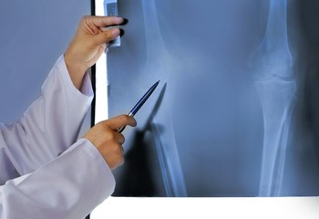 Female doctor hand using pen to pointing knee join x-ray film on glowing screen in radiology orthopedic unit at hospital, occupation and medical healthcare concept 