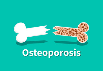 Osteoporosis, Bone structure in vector art design