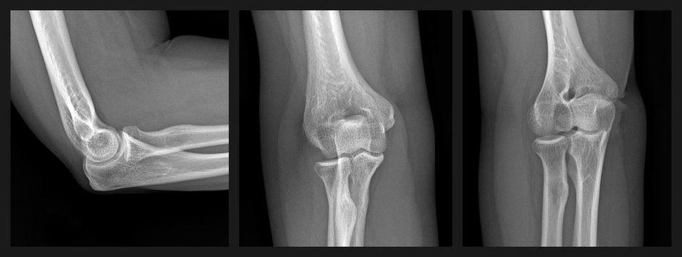 X-ray series of a human elbow joint showing the humerus bone of the upper arm and the radius and ulna bones of the forearm.