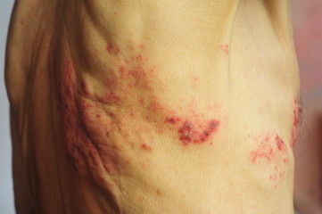 Shingles is a viral infection that causes a painful rash - obrazy, fototapety, plakaty