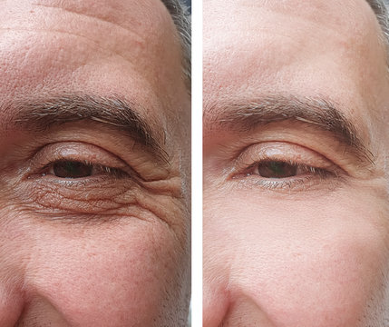 Male Wrinkles Before And After