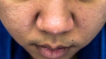 Obraz premium Facial acne is Asian women aged 25-30 and pores wrinkles are allergic to cosmetics.