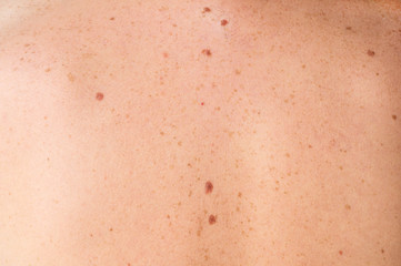 Close up detail of the bare skin on a man back with scattered moles and freckles. Checking benign moles. Sun effect on skin. Birthmarks on skin