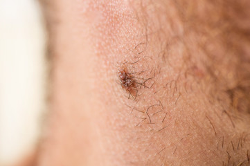 Fototapeta premium Close up detail of the bare skin on a man back with scattered moles and freckles. Checking benign moles. Sun effect on skin. Birthmarks on skin