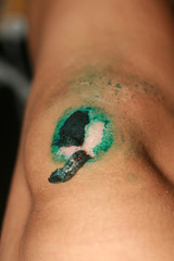 Healing wound on the knee. The wound treated with brilliant green. The scab will climb