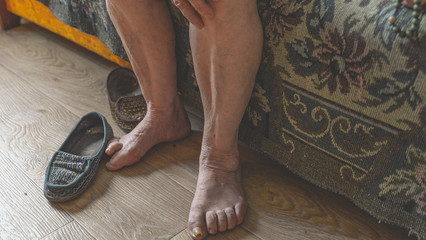 old feet, damaged toes and wrinkled legs with veins of old woman. Old shoes with holes. Coronavirus risk group. COVID virus infection.