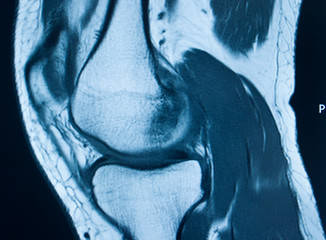 Knee injury mri mcl tear