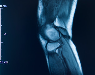 Knee injury mri mcl tear