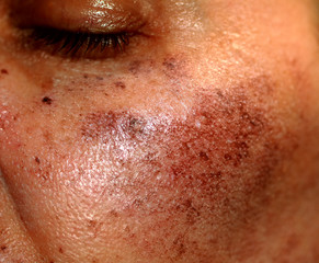 Pigmented spots on the face. Pigmentation on cheeks