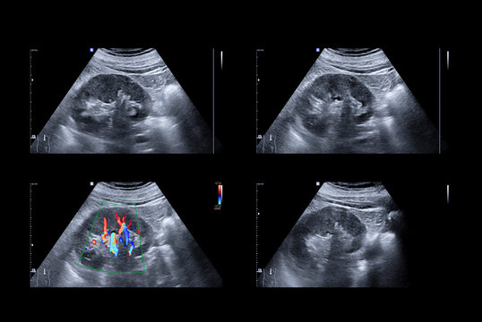 Ultrasound upper abdomen or ultrasound kidney showing  anatomical of kidney.