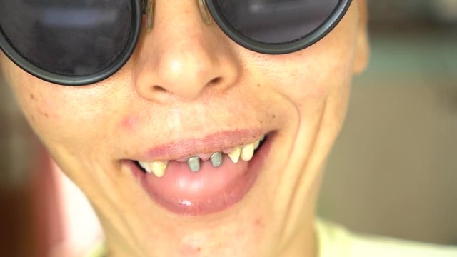 Ugly smile dental problem. Teeth Injuries or Teeth Falling in female. Post and core