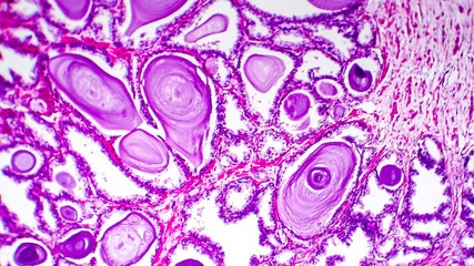 Histopathology of prostate gland hyperplasia, light micrograph, photo under microscope
