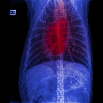 44 件の最適な ブラストミセス症 画像、ストック写真、ベクター Adobe Stock