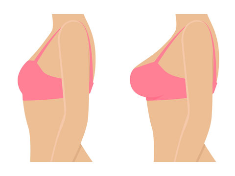 Female breasts in bra before after augmentation