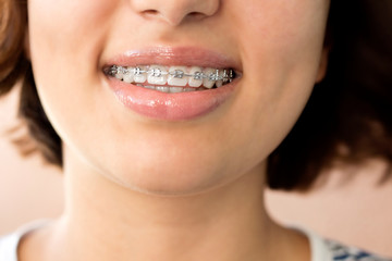 Naklejka premium Happy smile of young woman with dental braces