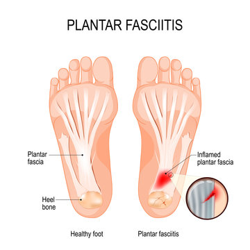 Plantar fasciitis. disorder of the connective tissue which supports the arch of the foot