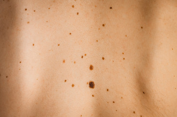 Moles on the back of a man.