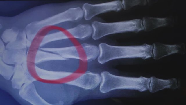 X-ray of a broken hand bone. Doctor shows fracture. Healthcare insurance concept.