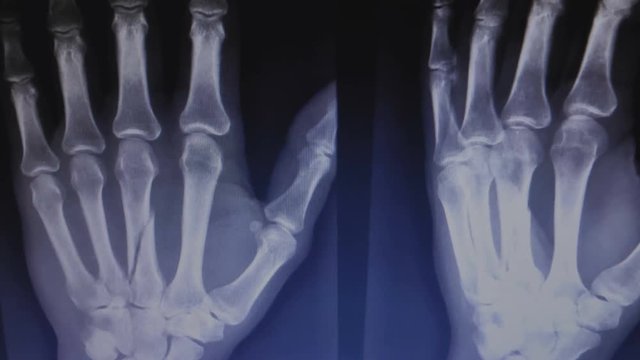 X-ray of a broken hand bone. Doctor shows fracture. Healthcare insurance concept.