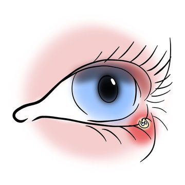 Angry sty on the lower eyelid