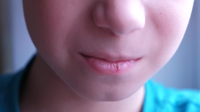 Little cracked cut on boy's lip. Child boy with herpes sore on the lip, mouth closeup. Process of dehydration during illness.