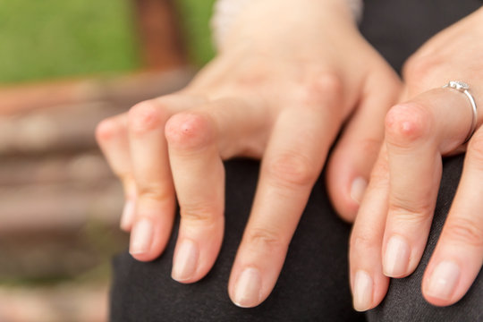 Young woman having rheumatoid arthritis takes a rest sittinng on a bench at a yard of a hospital. Hands and legs are deformed. She feels pain. Selected focus.