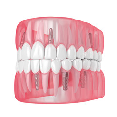 3d render of jaw with dental implants