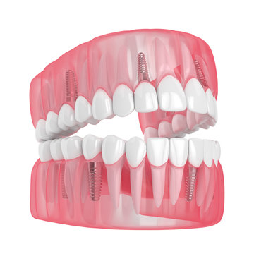 3d render of jaw with dental implants