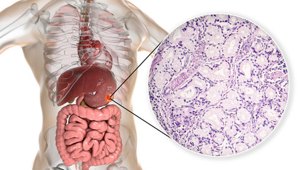Mucinous adenocarcinoma of stomach, gastric cancer, 3D illustration and micrograph
