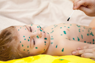 Home treatment of varicella. Small Caucasian girl with chicken pox. An antiseptic solution for the...