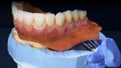 Fototapeta na wymiar Dental prosthesis with a gum on a titanium beam of the upper jaw on a black background