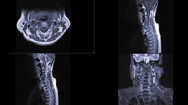 Comparison of MRI C-spine or magnetic resonance image of cervical spine Axial , Coronal and sagittal plane showing spondylosis  and compression fracture.