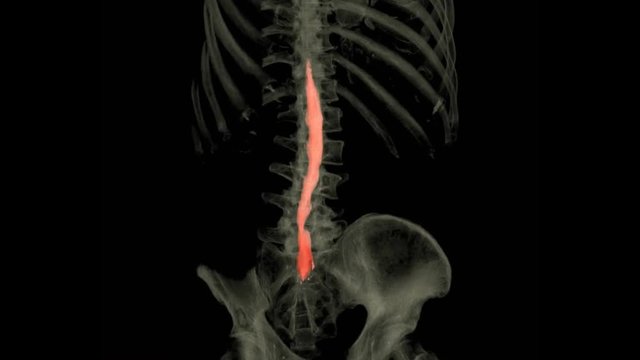 CT myelography with whole spine 3D rendering image is particularly sensitive at detecting small disk herniations compressing nerves of the spine from CT scanner. 