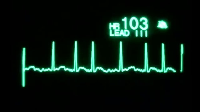 ECG in patients 