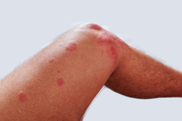 Around  legs of men with dermatitis problem of rash ,allergy rash and Health problem.