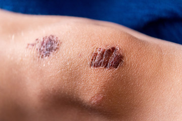 Fototapeta premium Schürfwunde am Knie eines Kindes mit roter Kruste aus Blut nach einem Ausrutscher beim Spielen und Toben in der Schule auf dem Pausenhof