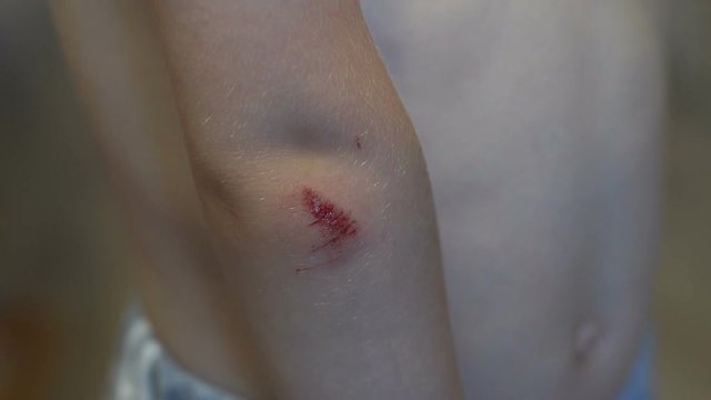 Close-up of a scratch with blood on the hand of a small child. The wound on the boy's skin. The child fell on the street and hurt the skin on his hand. Slow motion.