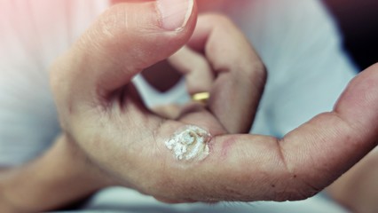 wart on finger after treatment by salicylic acid. wart on the finger verruca freeze,  healthcare and medical concept, blurred neutral light background from the window, selective focus