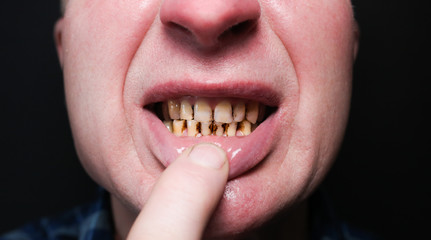 Plaque teeth cavities and paradontosis in the man's mouth. Dental decay problems and bad smile....