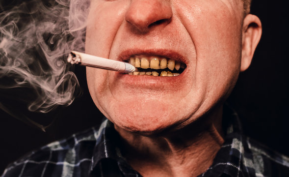 Cigarette in the man's mouth. Plaque teeth cavities and paradontosis. Smoking causes dental decay problems and bad smile. Dentist treatment concept. Harmful habit.