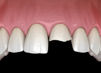 Broken central incisor tooth. Medically accurate 3D illustration of human teeth and dentures concept