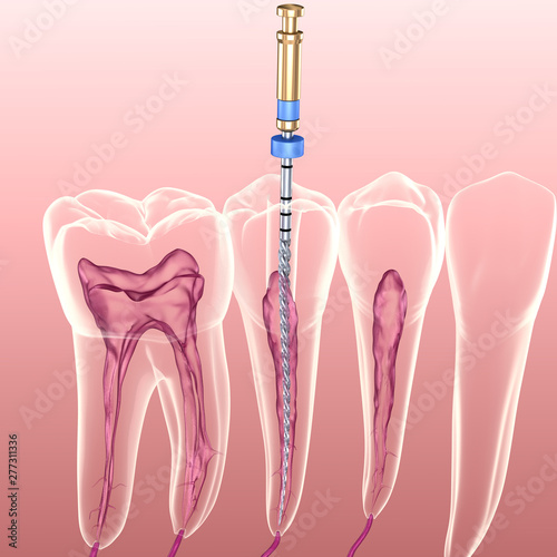 Endodontic Root Canal Treatment Process Medically Accurate Tooth