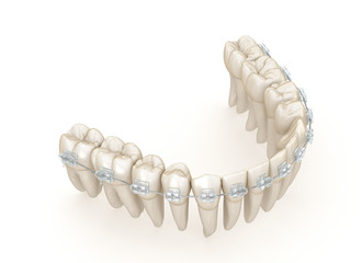 Teeth and Clear braces. 3D illustration concept