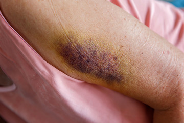 Large dark bruises  or hematoma on arm of an elderly person. Painful accident.