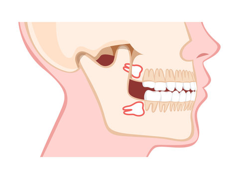 Human jaw with wisdom teeth side view