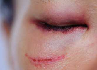 Black or bruised woman eye