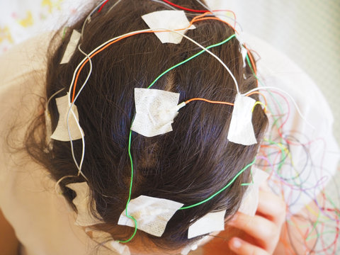 Girl with EEG electrodes attached to her head for medical test
